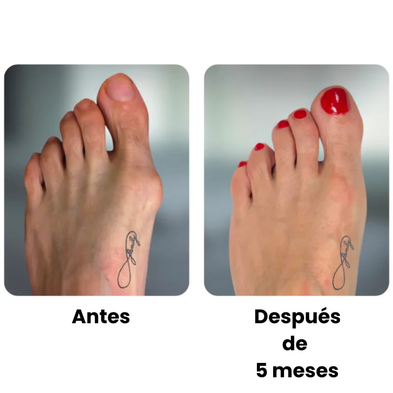 Corrector Ajustable de Juanetes